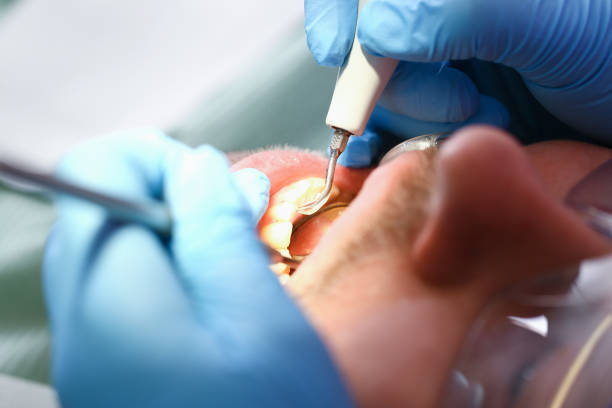 Best Knocked-Out Tooth (Avulsed Tooth) Treatment in Snoqualmie, WA