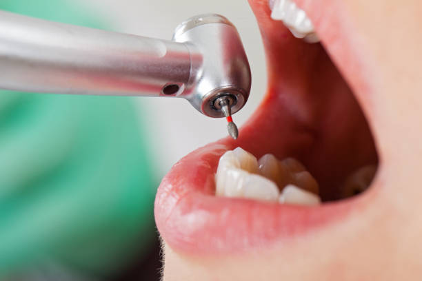 Best Broken or Chipped Tooth Repair in Snoqualmie, WA